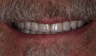 After: New dentures with implants