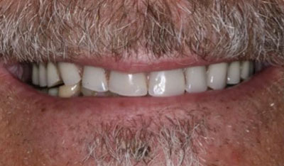 Before: New dentures with implants