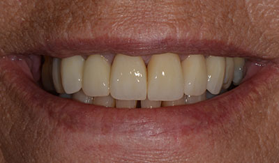 After: Front crowns