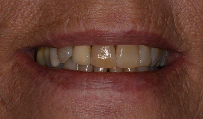 Before: Front crowns
