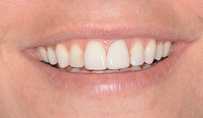 After: Front crowns