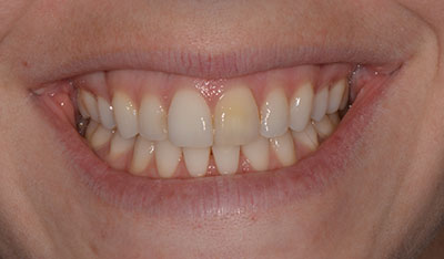 Before: Front crowns