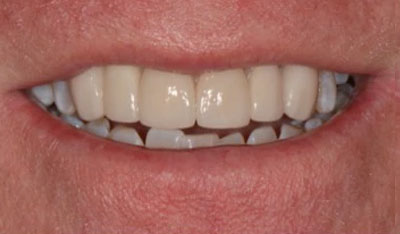 After: Front crowns