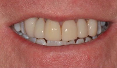 Before: Front crowns