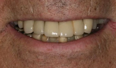 After: Front implants and crowns