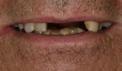 Before: Front implants and crowns