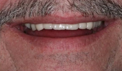 After: Front implants and crowns