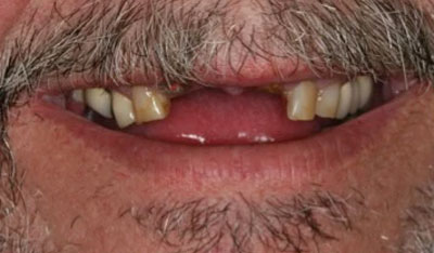 Before: Front implants and crowns