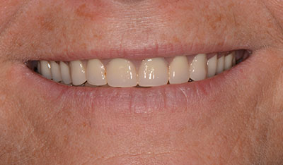 After: Full dentures