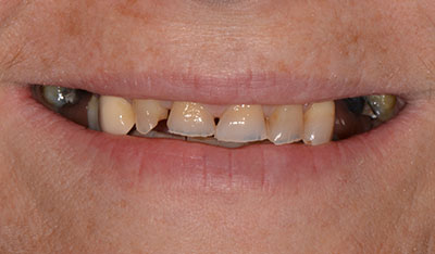 Before: Full dentures
