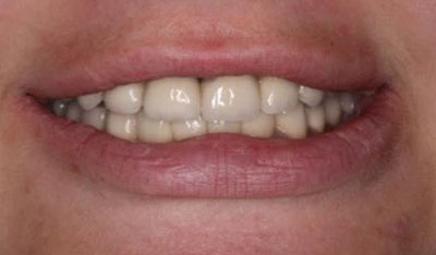 After: Smile makeover, crowns, and implants