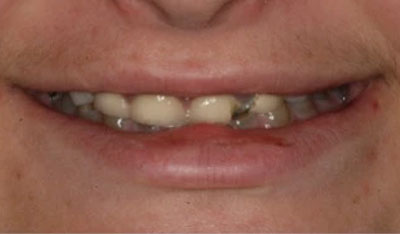 Before: Smile makeover, crowns, and implants