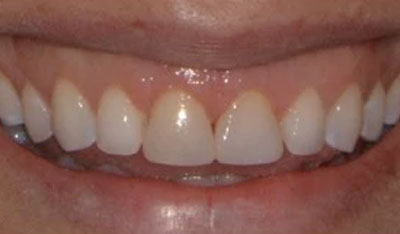 After: Gum rejuvenation and new bonding