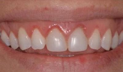 Before: Gum rejuvenation and new bonding