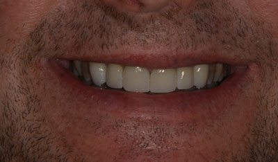 After: Invisalign