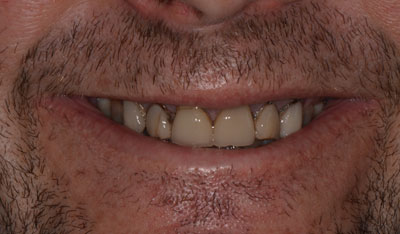 Before: Invisalign