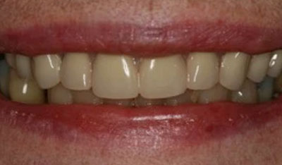 After: Upper dentures