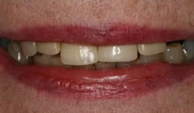 Before: Upper dentures